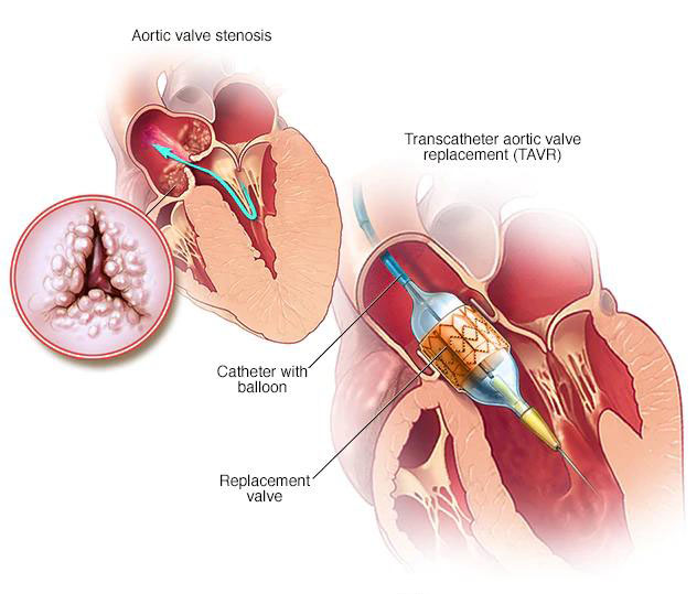 TAVR (Transcatheter Aortic Valve Replacement)